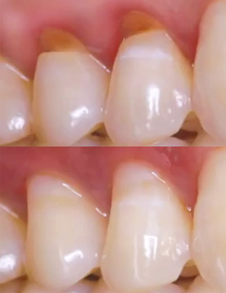 White fillings to correct abrasion