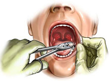 Les conséquences de l'extraction dentaire