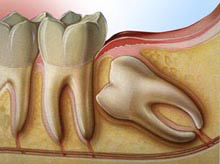Operculum Dental